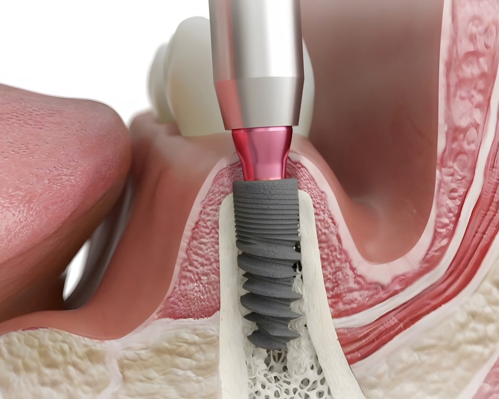 dental implant in a jawbone