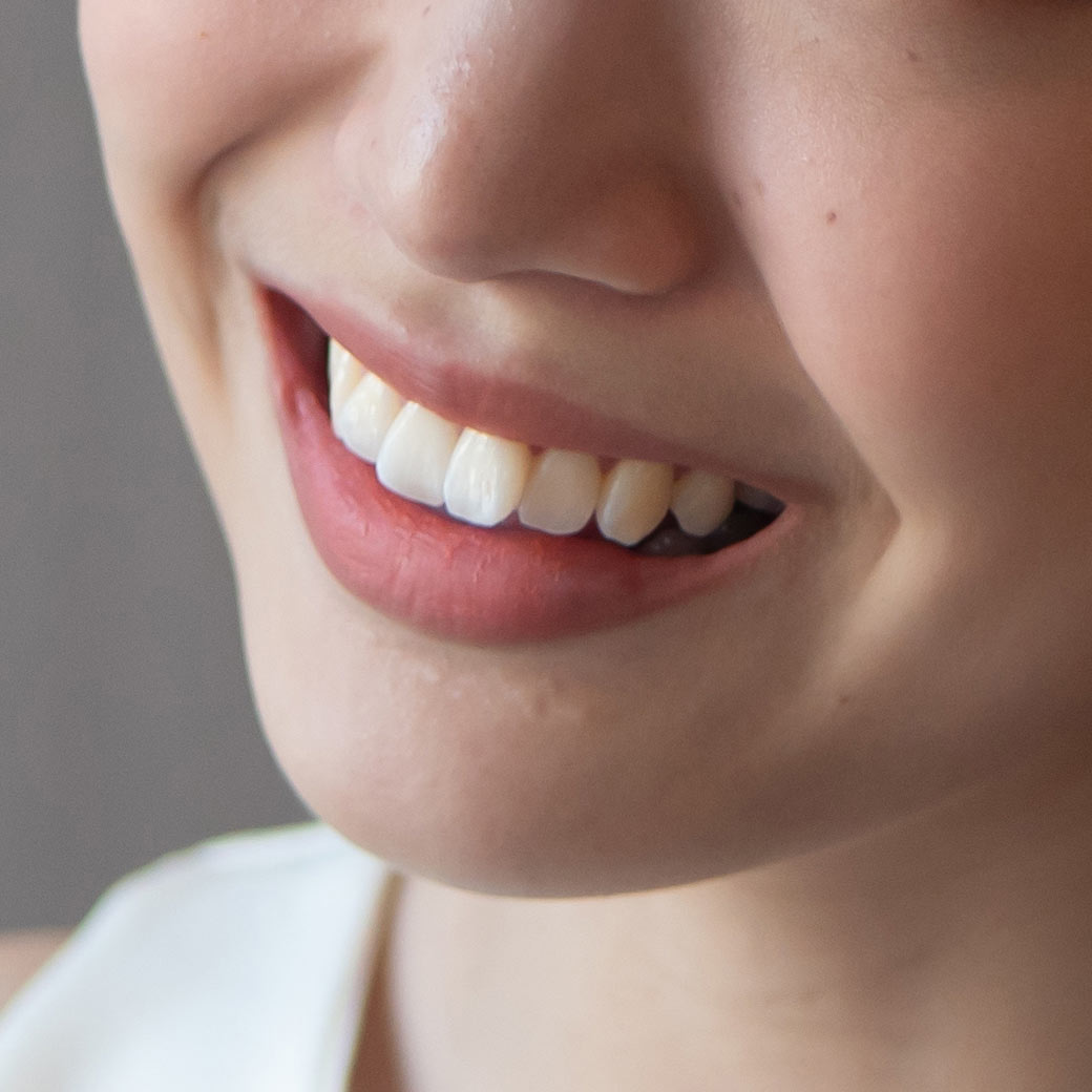 misaligned top teeth