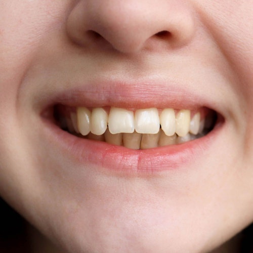 moderately crooked teeth