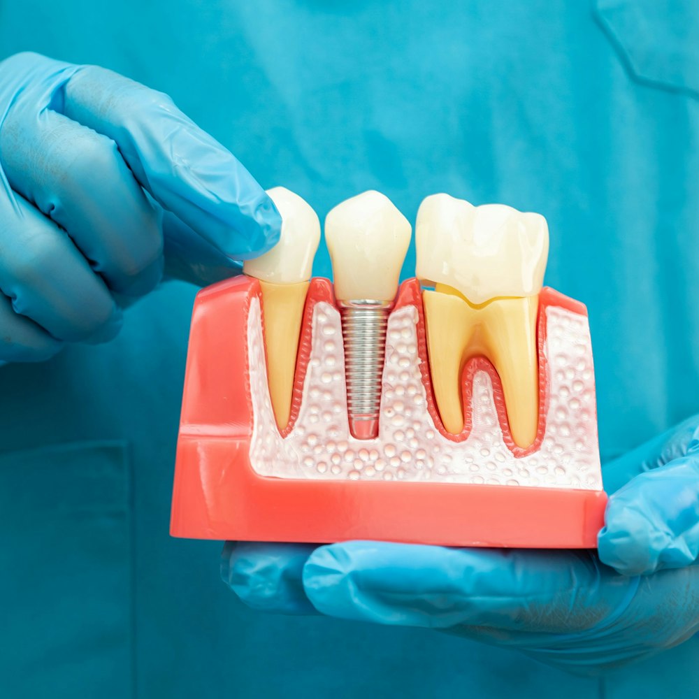 dental implants diagram