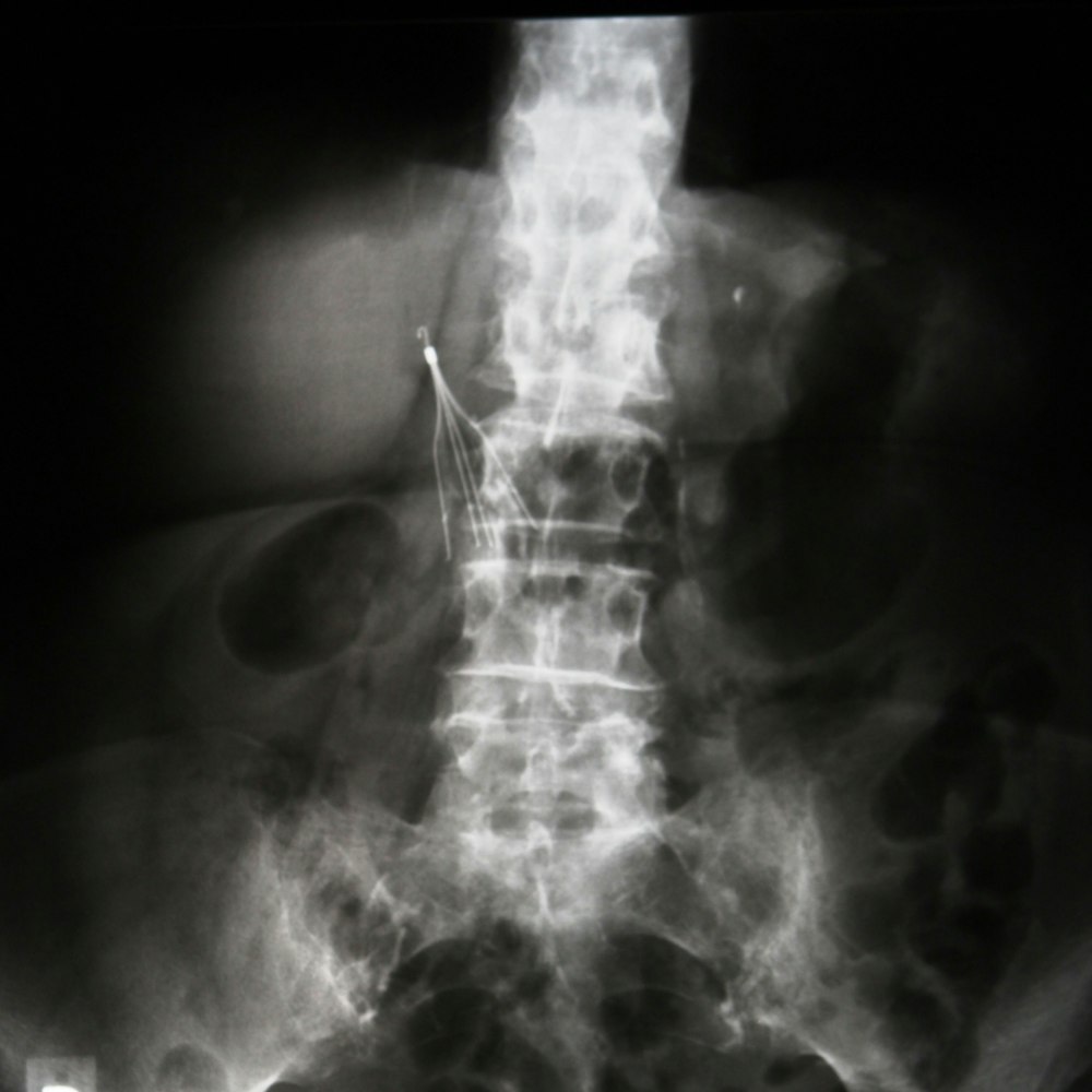 IVC Filter