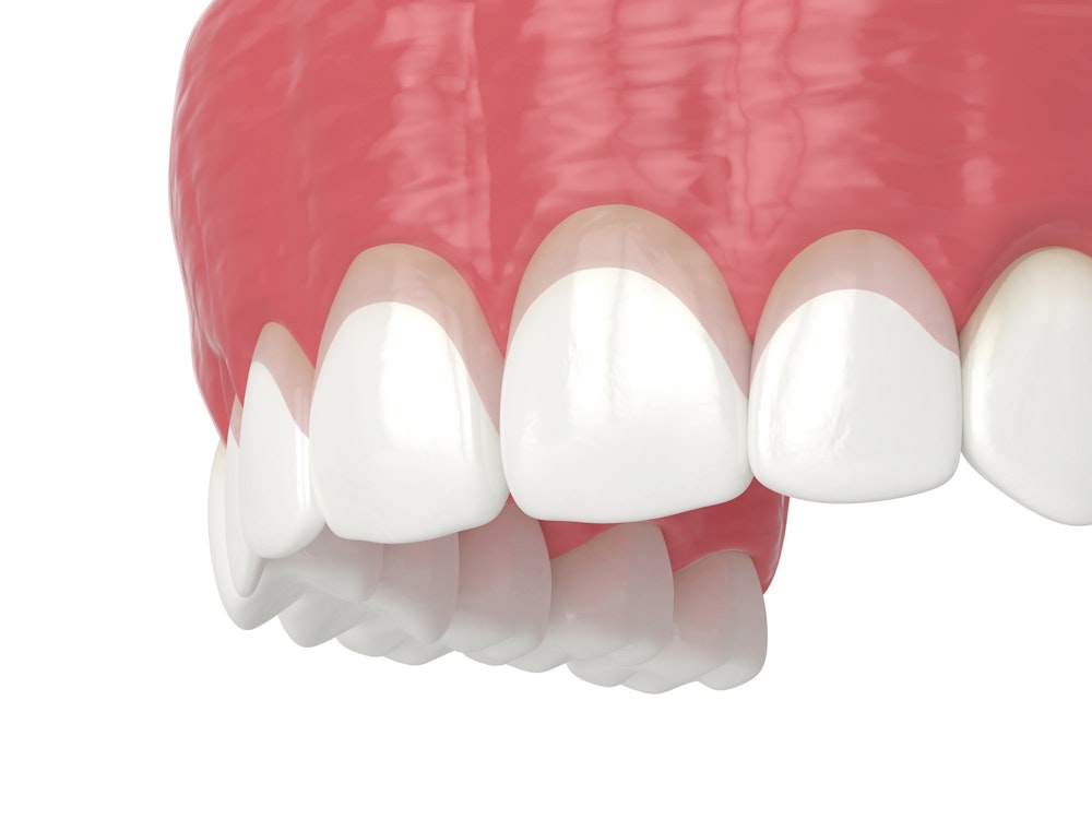 illustration demonstrating the gum contouring procedure