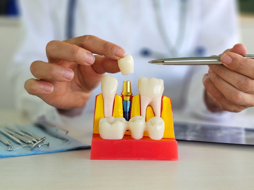 dentist pointing to implant-supported crown model