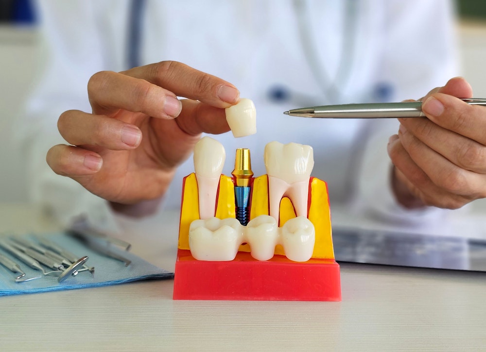 dentist pointing to implant-supported crown model