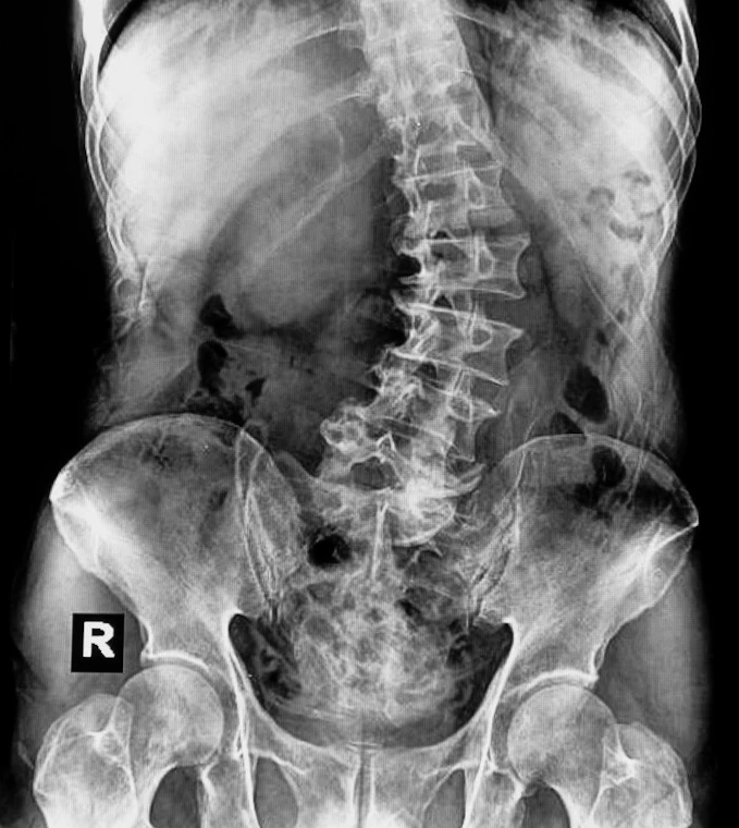 Photo of an x-ray of scoliosis