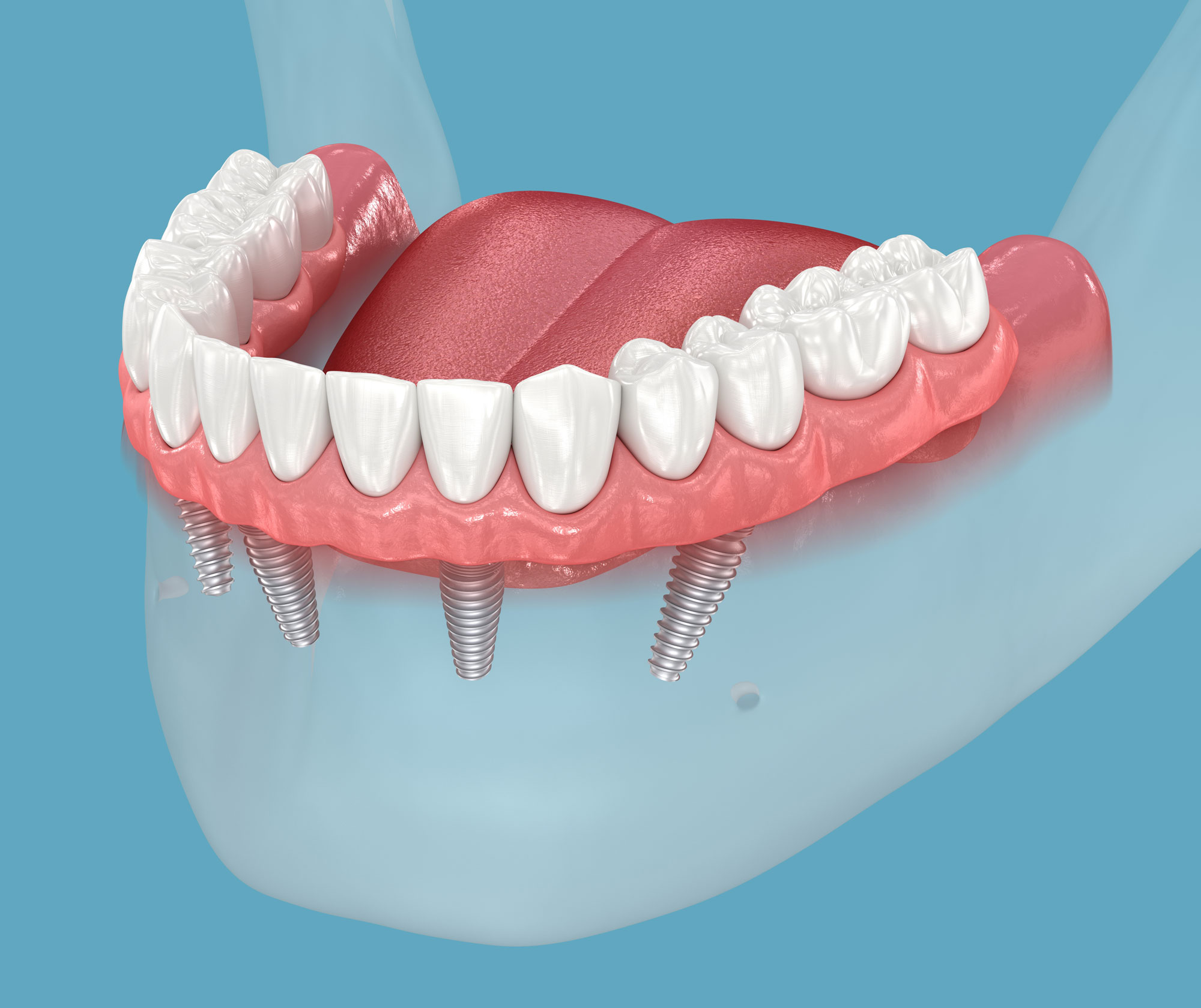 implant-supported denture
