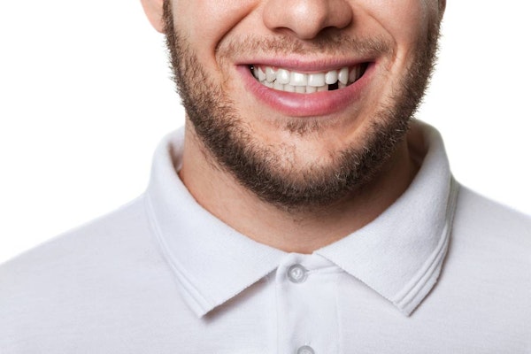 Smiling man with missing tooth