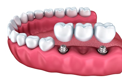 Close-up illustration of an implant-supported bridge.