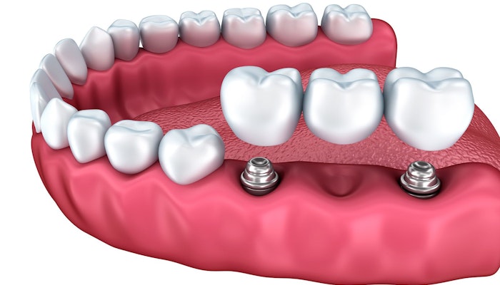 Implant-supported bridge