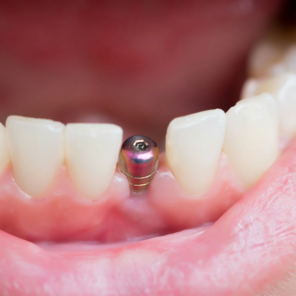 Dental Implants