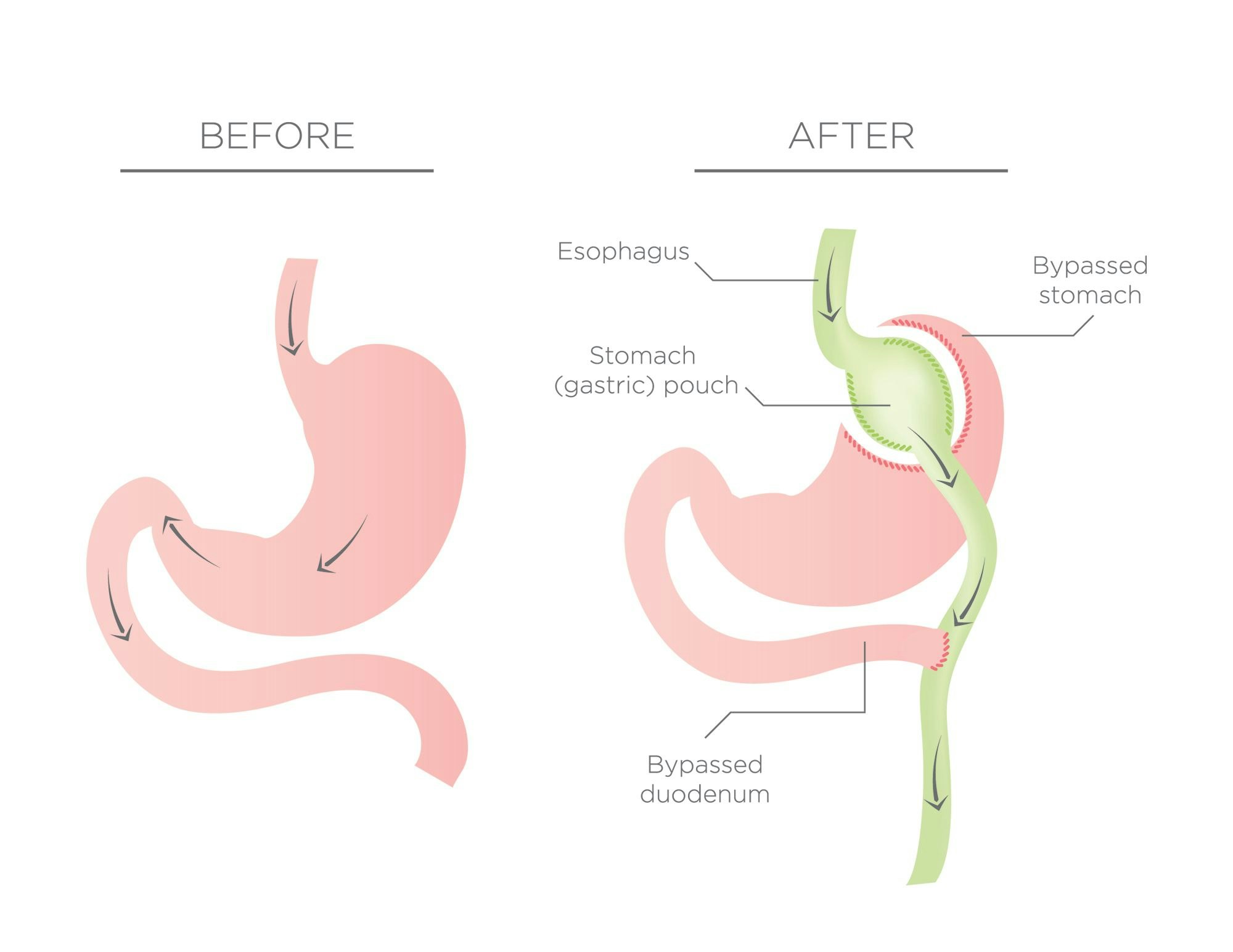 Before and after roux-en-y bypass