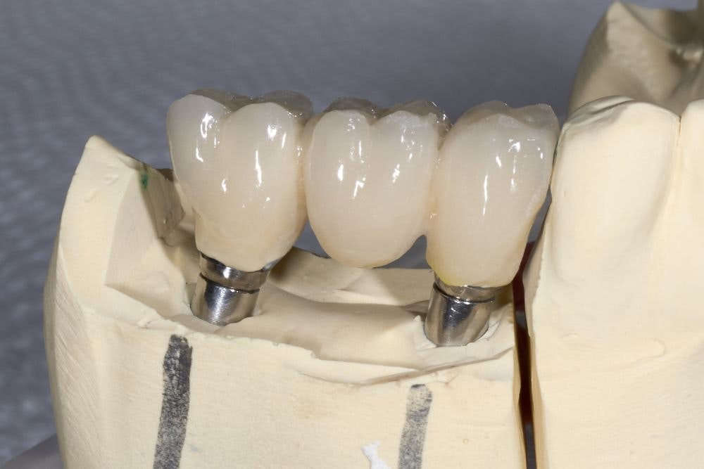 Implant bridge