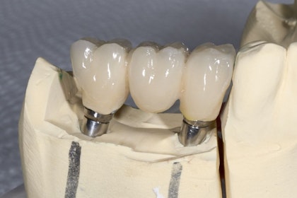 Implant bridge