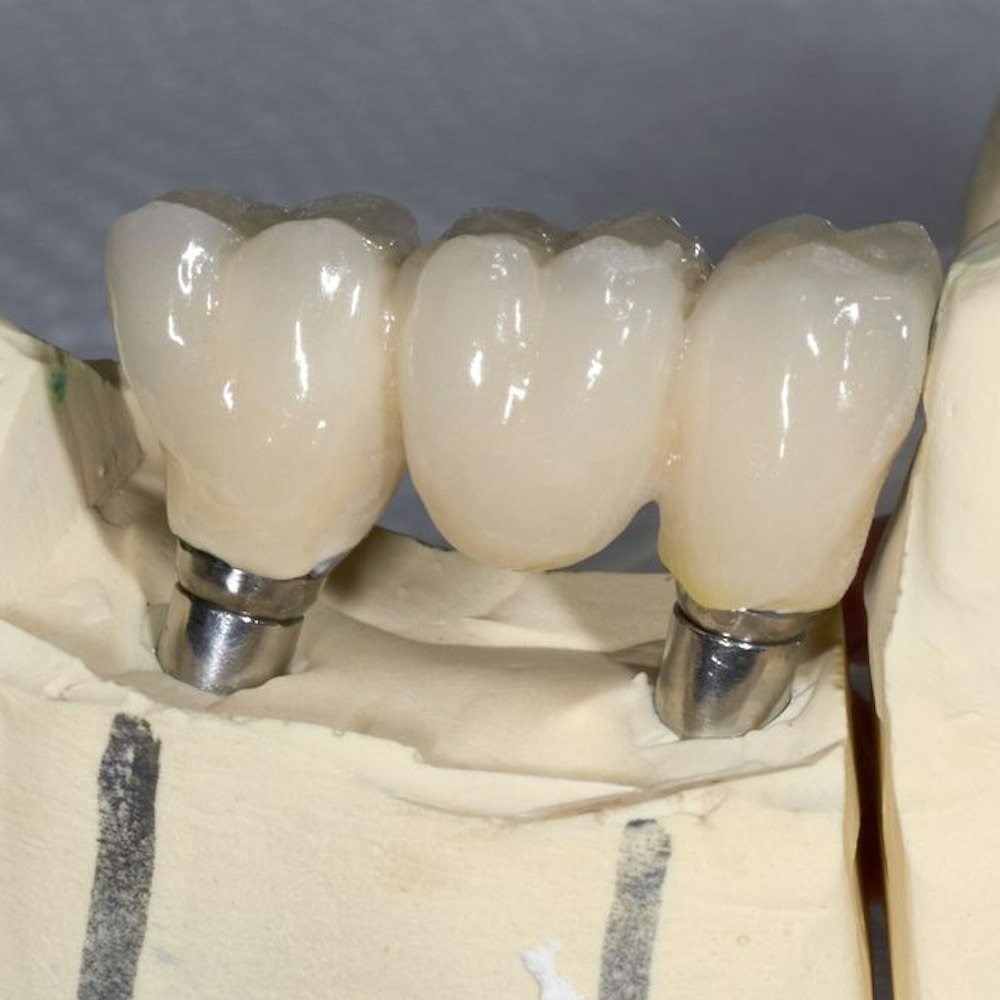 Implant-supported bridge
