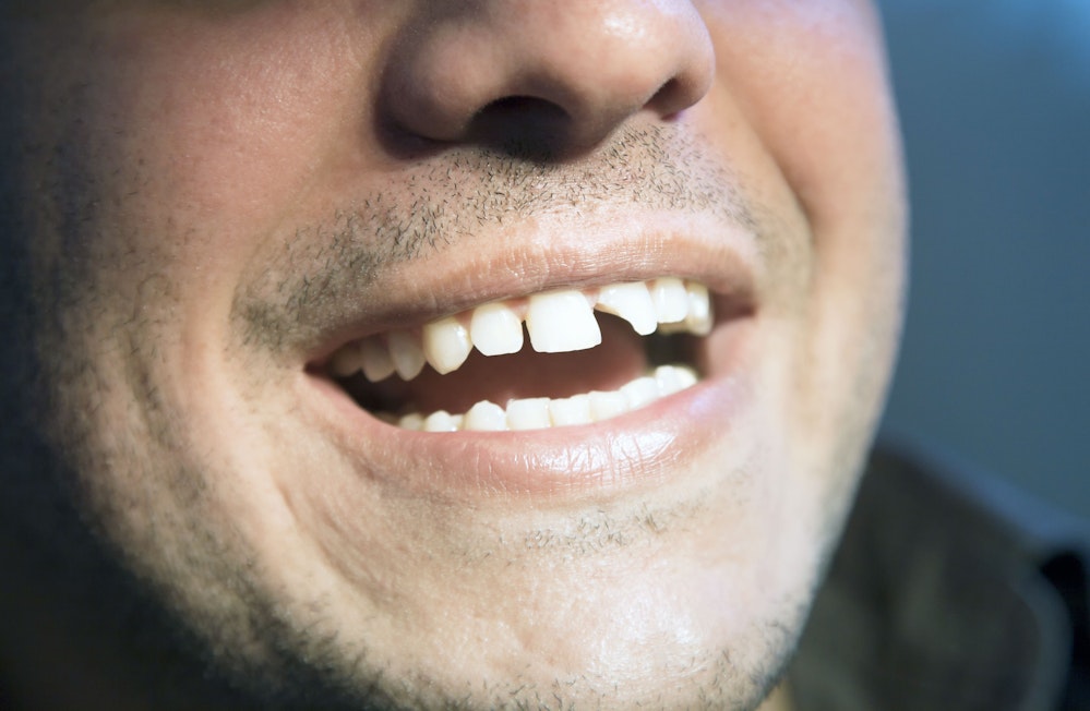 Man with chipped tooth