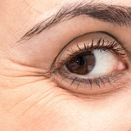 Eye with signs of aging