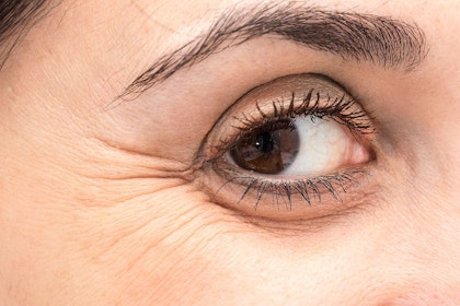 Eye with signs of aging