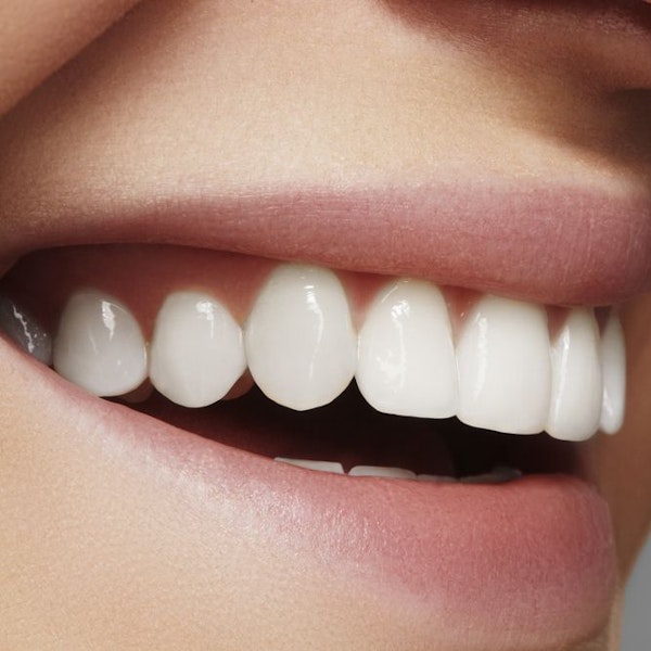 Whitened teeth