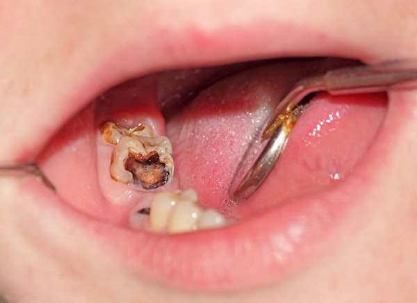Close up of tooth decay