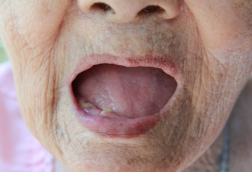 old lady's mouth with no teeth