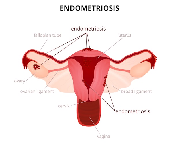 Endometriosis diagram