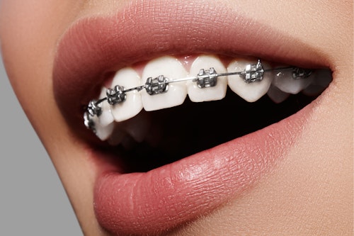Orthodontic Treatment