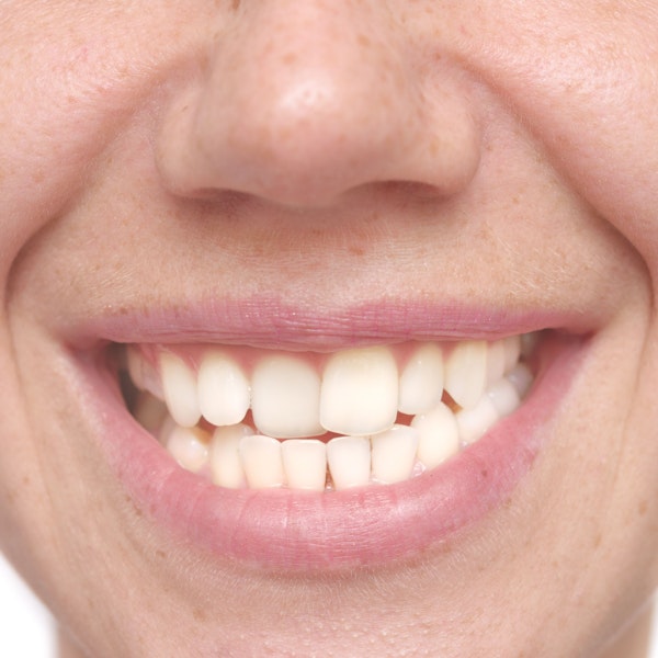 Close up of woman's crooked teeth