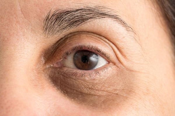 Mature woman with saggy upper eyelid