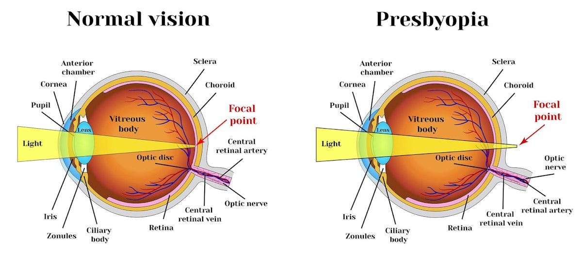 Normal eye showing how light enters the vitreous body through the cornea (connected to the sclera), anterior chamber, iris, pupil, and lens