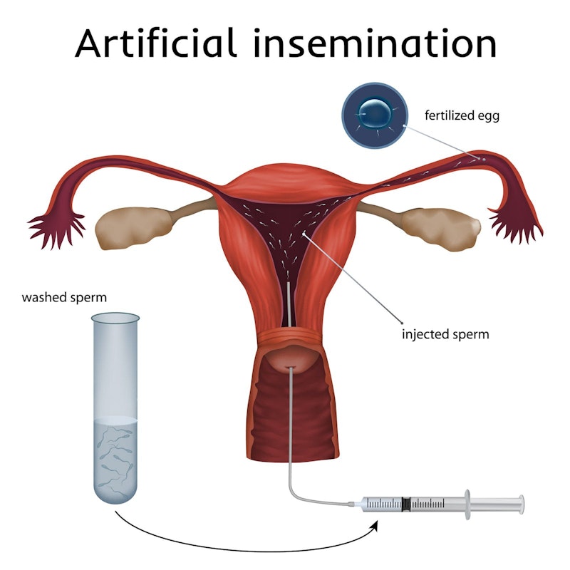 Illustration of artificial insemination
