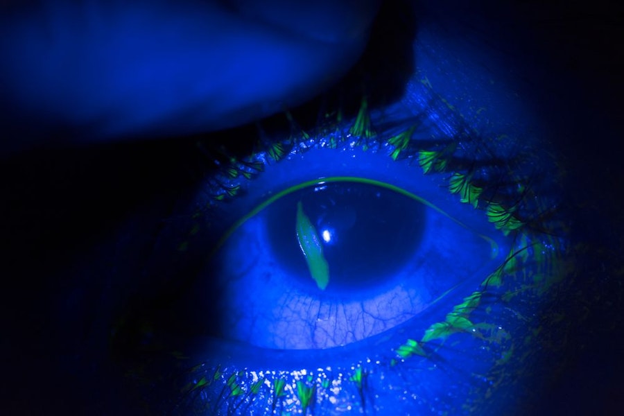 Close up of corneal abrasion during eye examination in dark room.