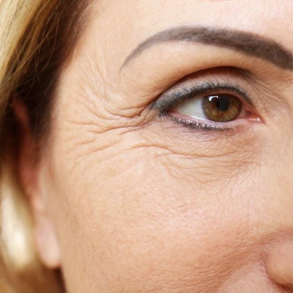 Wrinkles surrounding eye