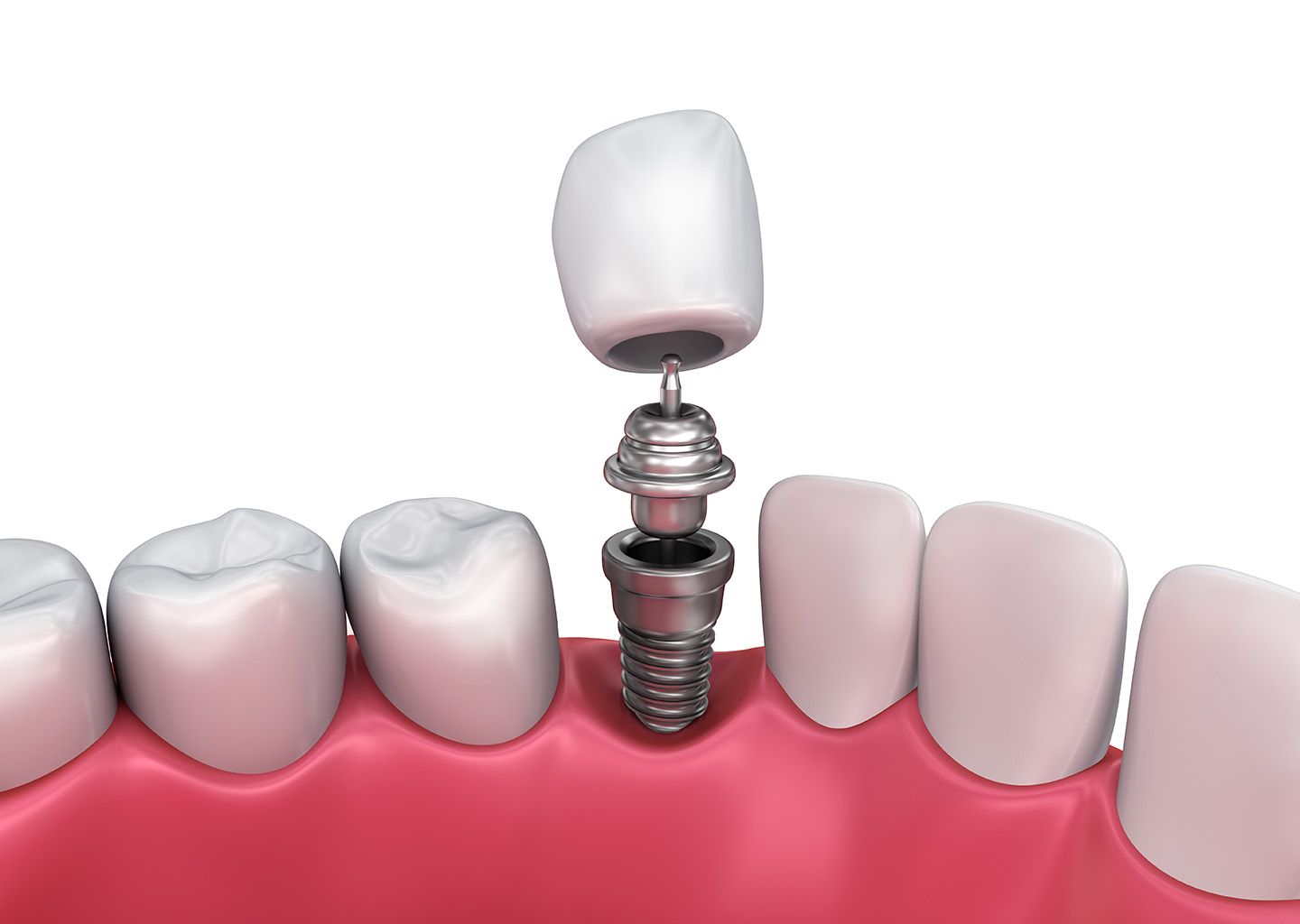 dental restoration illustration