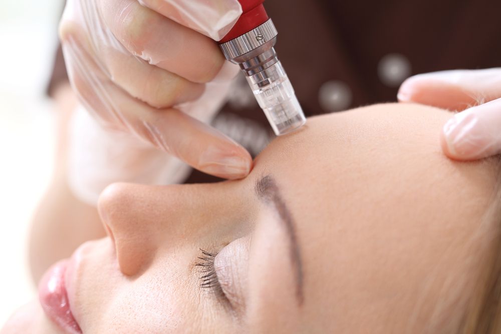 Close up of microneedling procedure