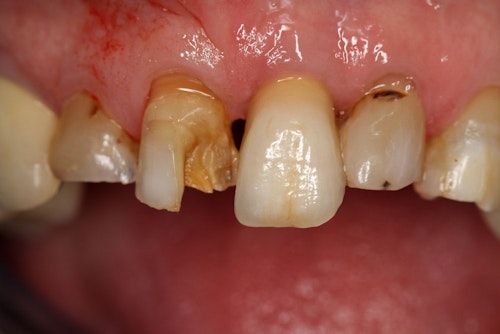 damaged teeth