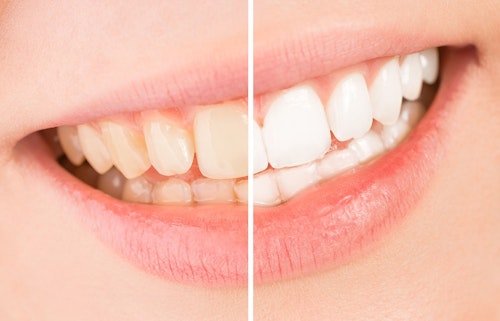 Tooth Whitening