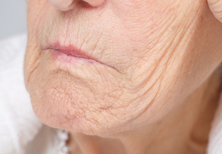sagging skin