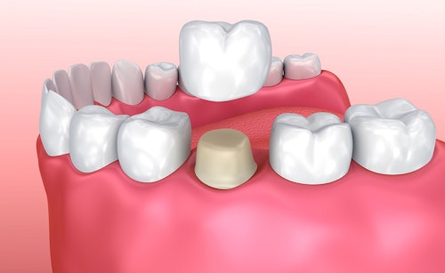 Illustration of porcelain dental crowns.