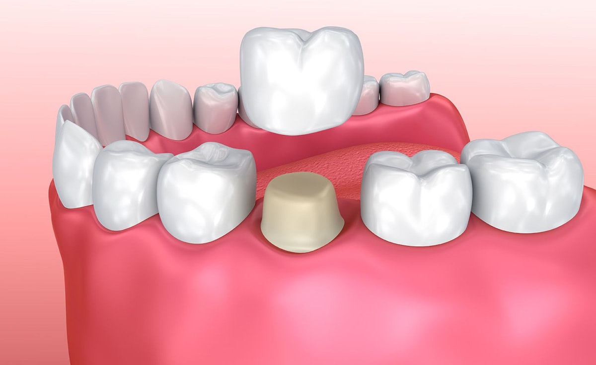 illustration of crown placement