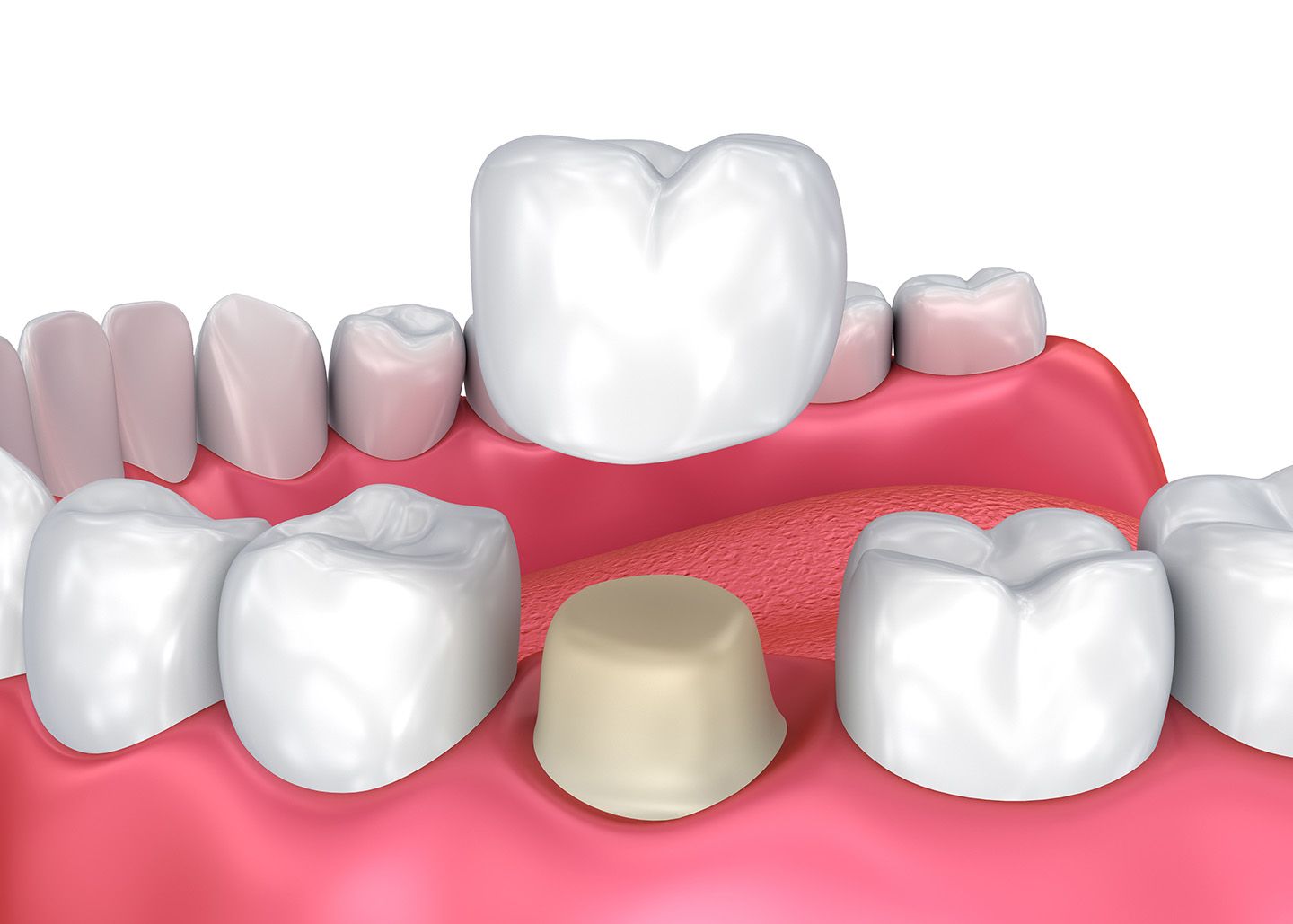 Digital close-up illustration of a row of teeth and crown