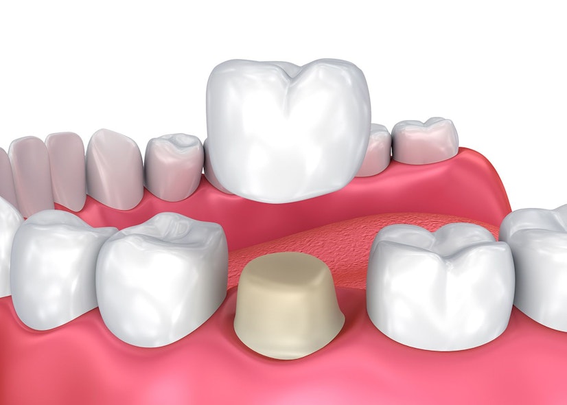 Digital close-up illustration of a row of teeth and crown