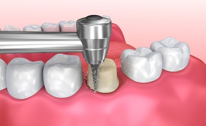 tooth being reshaped for crown