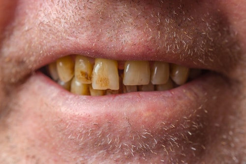 Closeup of stained teeth