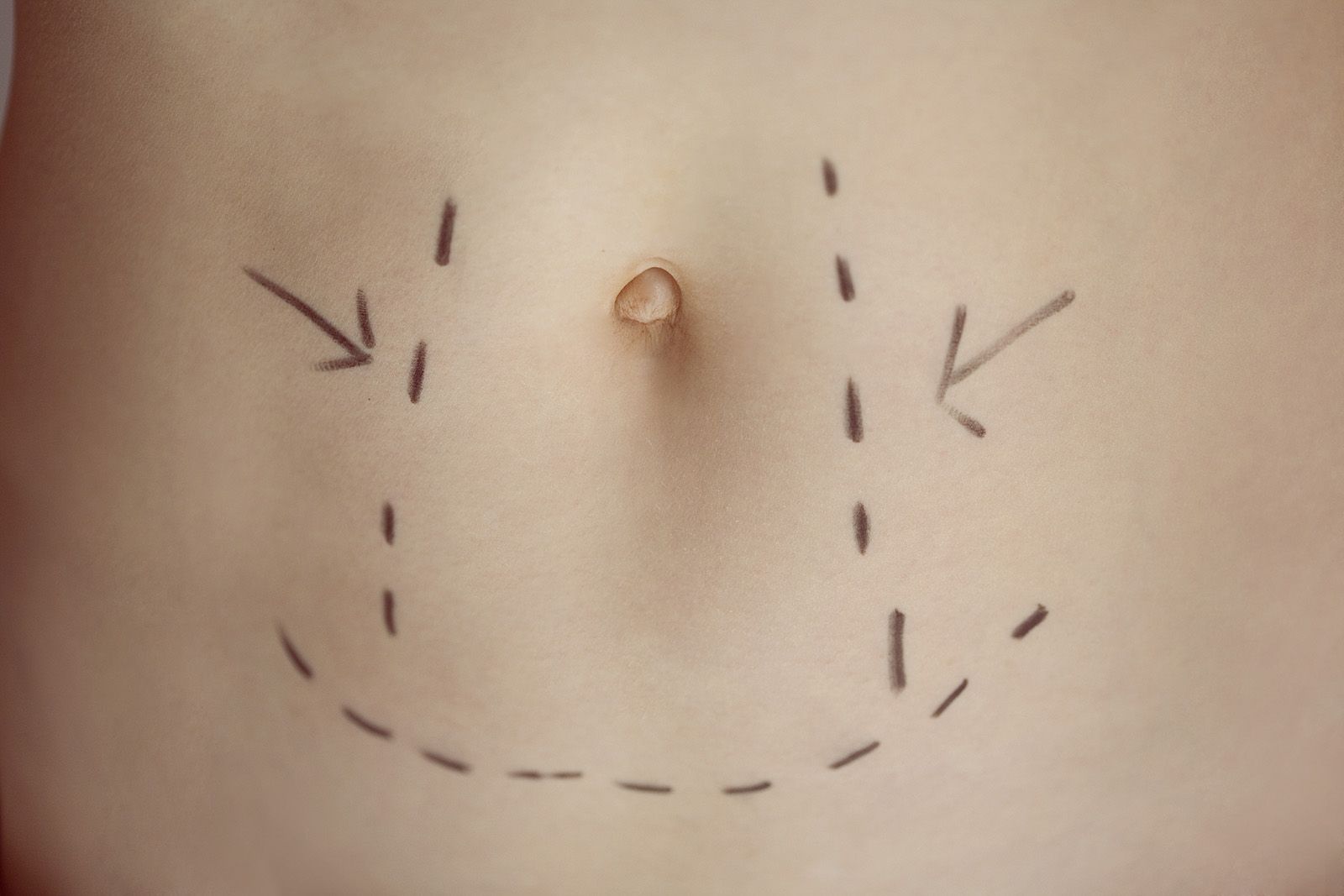 Tummy tuck areas marked on a woman's stomach 