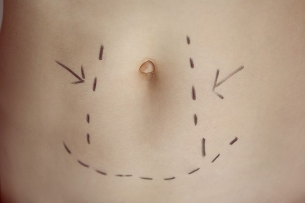 Tummy tuck areas marked on a woman's stomach