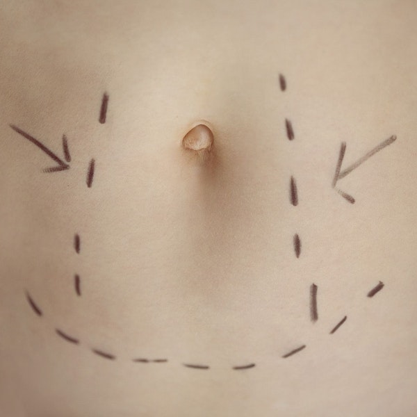 Tummy tuck areas marked on a woman's stomach