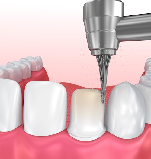 Illustration of root canal