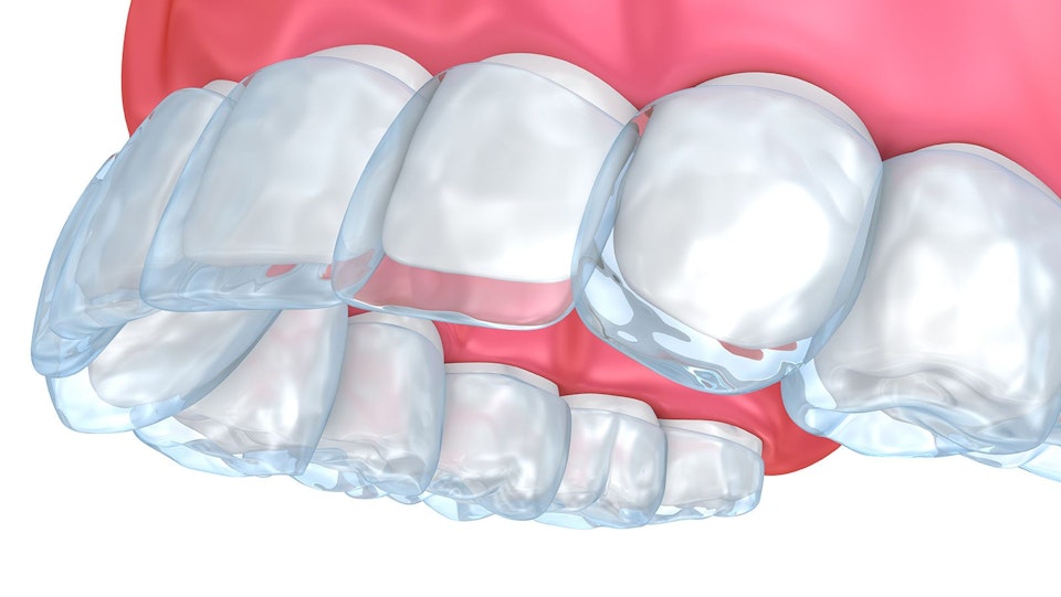5 Major Benefits of Invisible Aligners - Baptist Road Dental