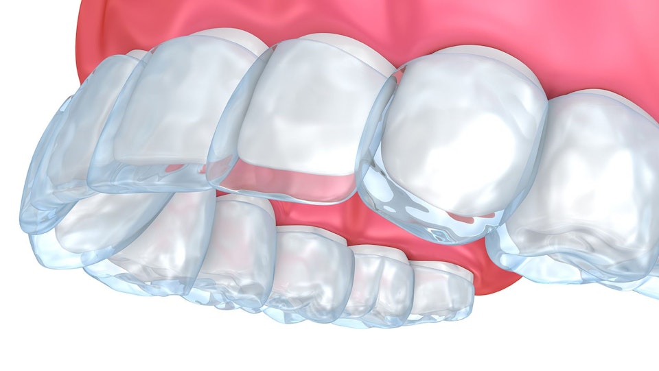 invisalign mouthpiece