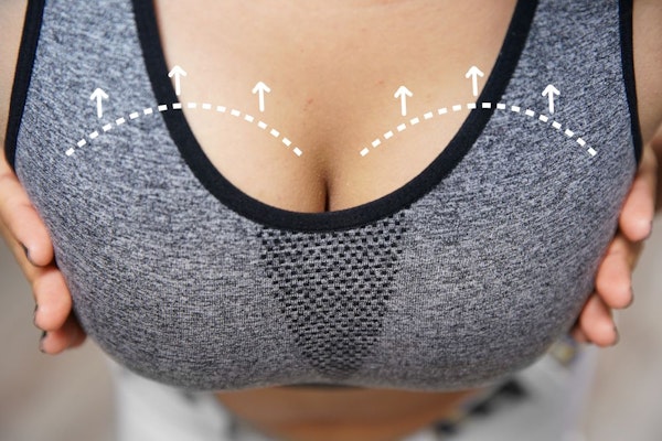 Breast lift procedure
